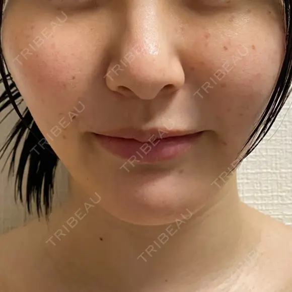 ピコスポット L‘amour clinic Tokyo【ラムールクリニック東京】 DAY 1 メイン用