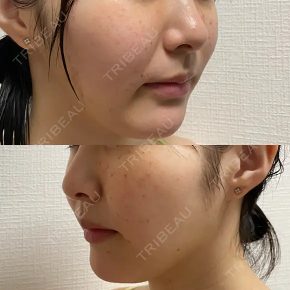 ピコスポット L‘amour clinic Tokyo【ラムールクリニック東京】 DAY 1 メイン用