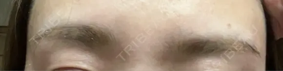 アートメイク除去・修正 LEAGRANT CLINIC 中目黒 DAY 7 メイン用