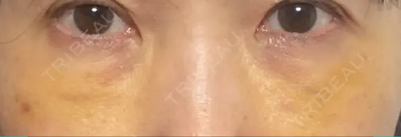 下まぶたの脂肪取り / 脂肪注入（肌） / 脂肪注入（目の下） X CLINIC 大阪院 DAY 7 メイン用