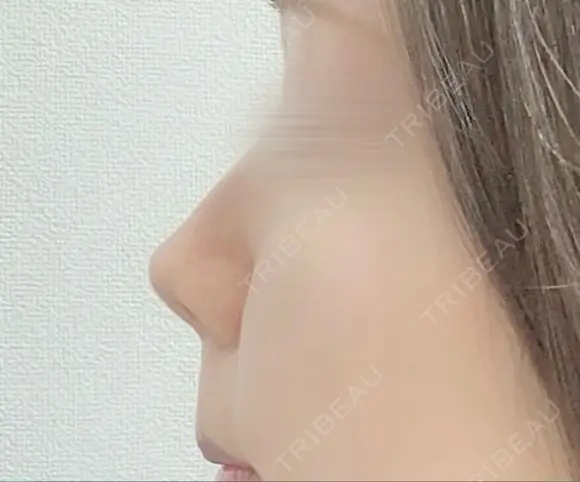 軟骨移植 ソウルクイーン整形外科（旧コエンミ整形外科） DAY 447 メイン用