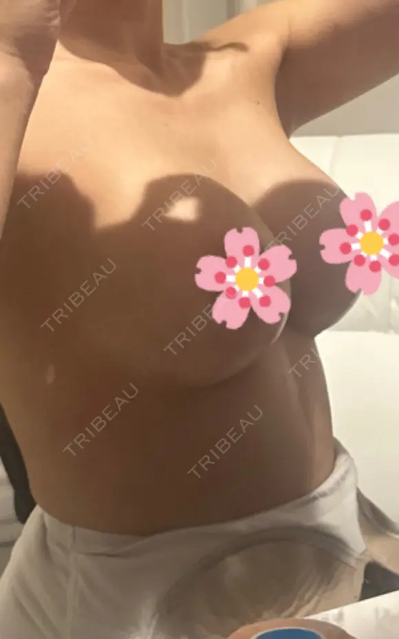 豊胸（シリコンバッグ） / ワキ汗治療（ボトックス） お茶の水美容形成クリニック DAY 10 メイン用