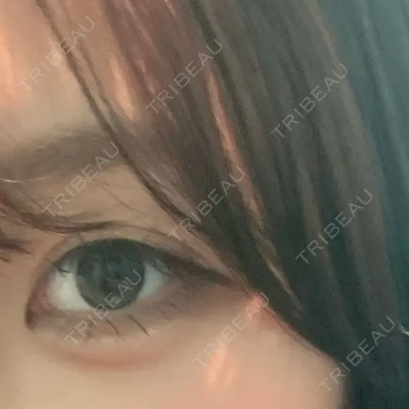 ヒアルロン酸注入（涙袋） ファイヤークリニック 銀座院 DAY 5 メイン用