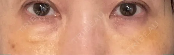 下まぶたの脂肪取り / 脂肪注入（肌） / 脂肪注入（目の下） X CLINIC 大阪院 DAY 7 メイン用