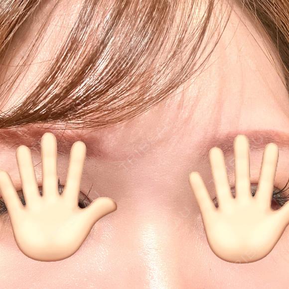 その他（鼻） / 小鼻縮小（非切開） / シワ取りボトックス / ボトックス（眉間） TCB東京中央美容外科 横浜駅前院 AFTER メイン用