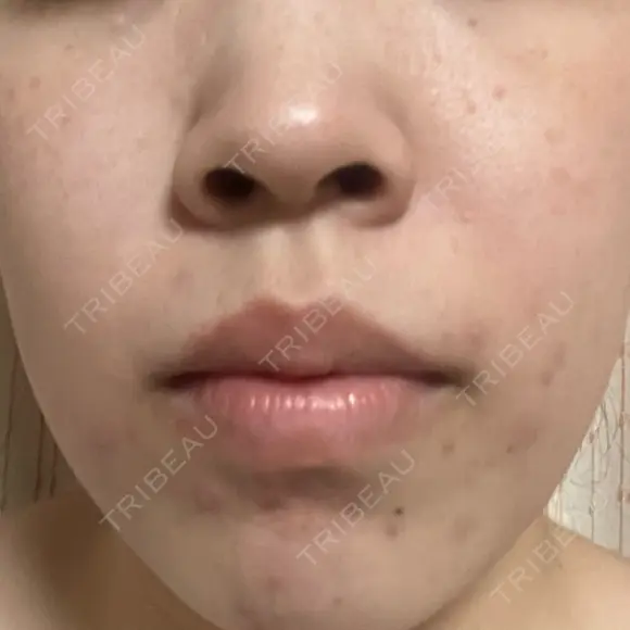 ポテンツァ 渋谷美容外科クリニック 横浜院 DAY 1 メイン用