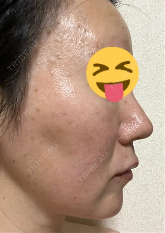 シミ取りレーザー / ピコスポット Olino美容外科・美容皮膚科 DAY 13 メイン用