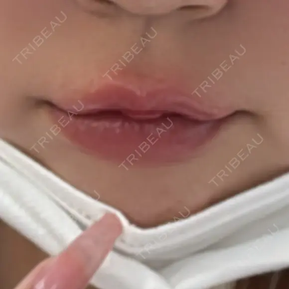 ヒアルロン酸注入（唇） / ボトックス（口角） ルラ美容クリニック 札幌本院 AFTER メイン用