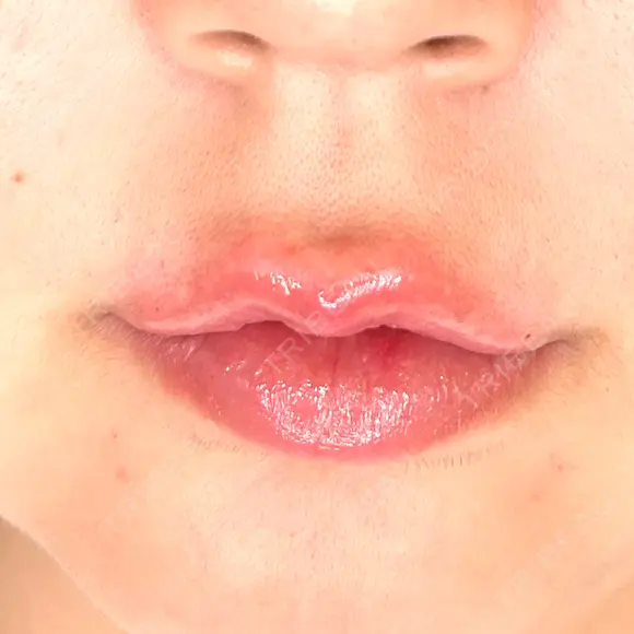ヒアルロン酸注入（唇） / ボトックス（口角） ルラ美容クリニック 札幌本院 DAY 0 メイン用