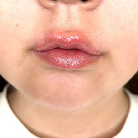 ヒアルロン酸注入（唇） / ボトックス（口角） ルラ美容クリニック 札幌本院 DAY 0 メイン用