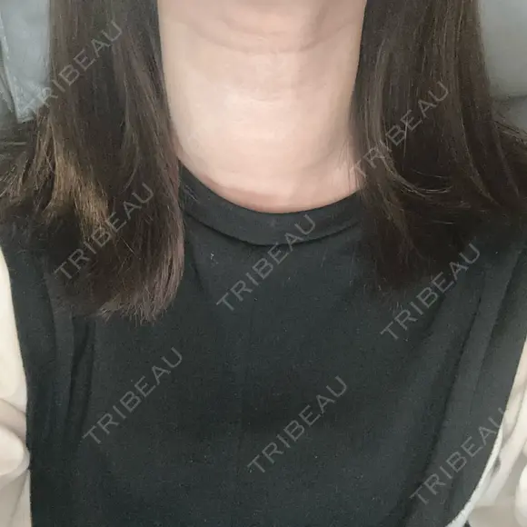 PRP皮膚再生療法 ノリス美容クリニック AFTER メイン用
