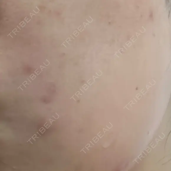 ポテンツァ 渋谷美容外科クリニック 横浜院 DAY 2 メイン用