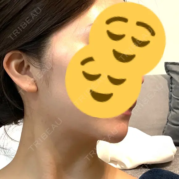 糸リフト / 脂肪吸引注射（顔） 湘南美容クリニック 吉祥寺院 DAY 82 メイン用