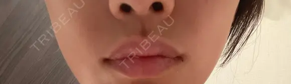 ヒアルロン酸注入（唇） お肌のクリニック　高田馬場 AFTER メイン用