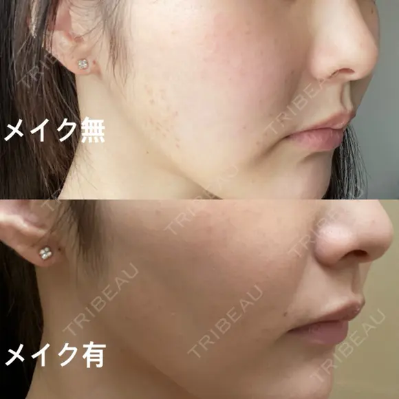 ピコスポット L‘amour clinic Tokyo【ラムールクリニック東京】 DAY 3 メイン用