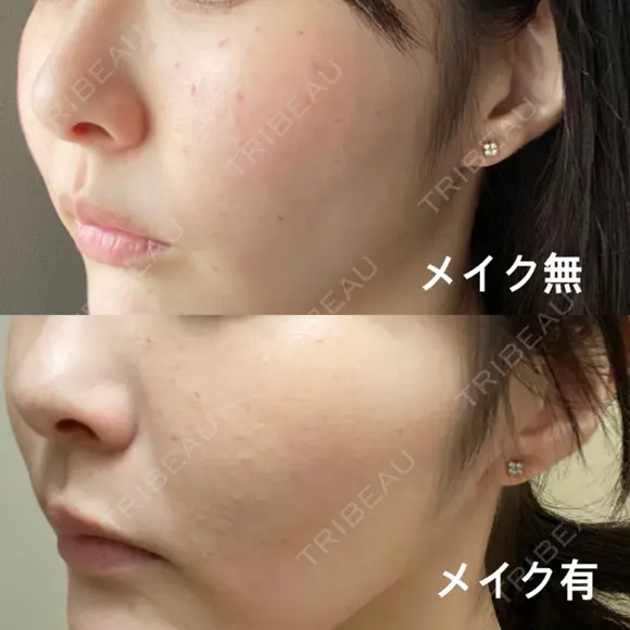 ピコスポット L‘amour clinic Tokyo【ラムールクリニック東京】 DAY 3 メイン用