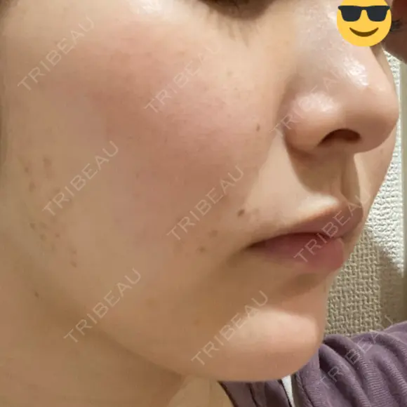 ピコスポット L‘amour clinic Tokyo【ラムールクリニック東京】 DAY 6 メイン用