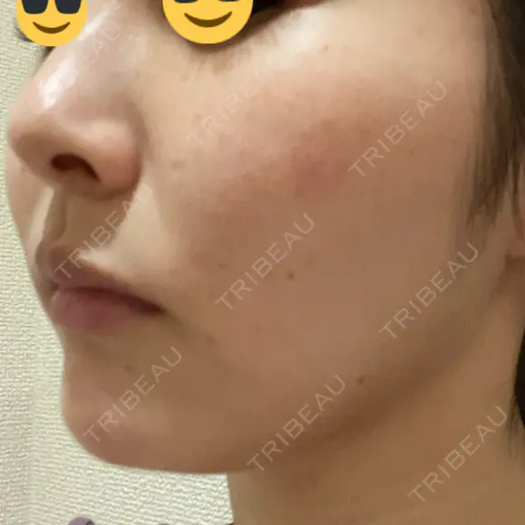 ピコスポット L‘amour clinic Tokyo【ラムールクリニック東京】 DAY 6 メイン用