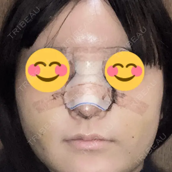 隆鼻術 / 鼻尖形成（切開） / 鼻中隔延長（切開） / 軟骨移植 R Beauty CLINIC 銀座院 DAY 8 メイン用