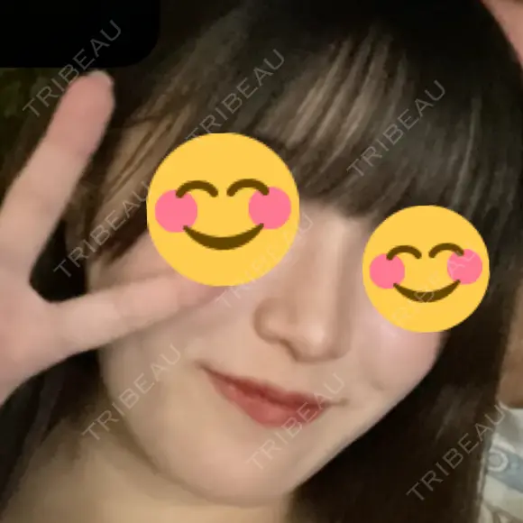 隆鼻術 / 鼻尖形成（切開） / 鼻中隔延長（切開） / 軟骨移植 R Beauty CLINIC 銀座院 DAY 113 メイン用