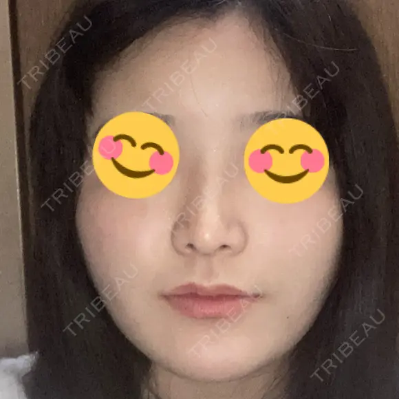 隆鼻術 / 鼻尖形成（切開） / 鼻中隔延長（切開） / 軟骨移植 R Beauty CLINIC 銀座院 DAY 42 メイン用