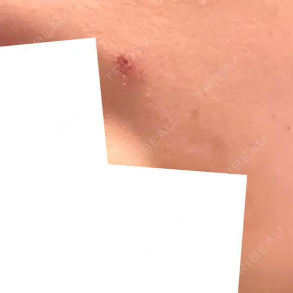 ほくろ・いぼ除去レーザー（肌） フェアクリニック川口 DAY 7 メイン用