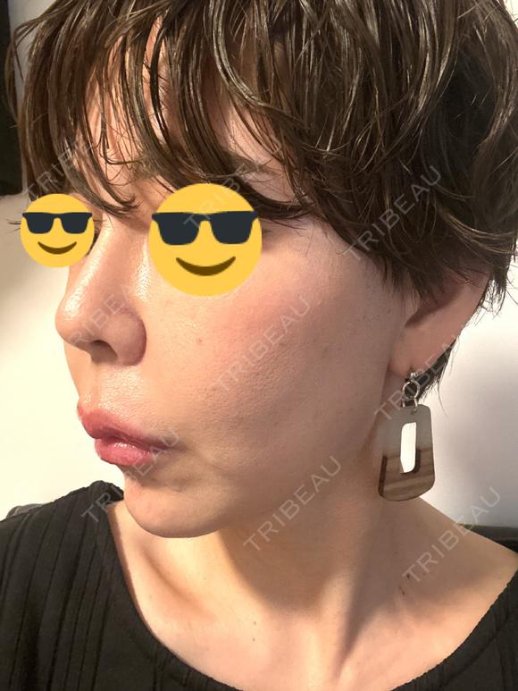 ヒアルロン酸注入（鼻） プリモ麻布十番クリニック DAY 3 メイン用