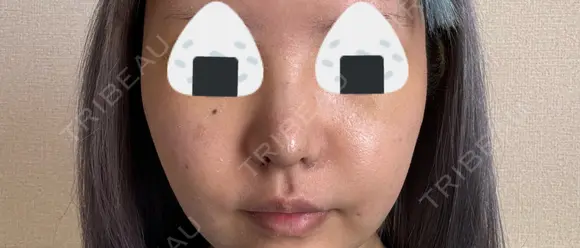 隆鼻術 / 鼻尖形成（切開） / 鼻中隔延長（切開） / 小鼻縮小（切開） / 軟骨移植 R Beauty CLINIC 銀座院 DAY 10 メイン用