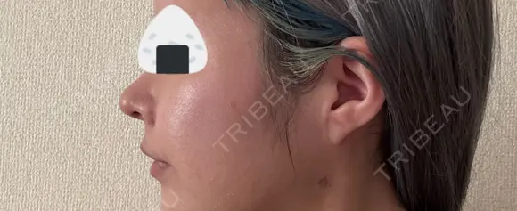 隆鼻術 / 鼻尖形成（切開） / 鼻中隔延長（切開） / 小鼻縮小（切開） / 軟骨移植 R Beauty CLINIC 銀座院 DAY 15 メイン用