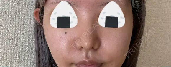 隆鼻術 / 鼻尖形成（切開） / 鼻中隔延長（切開） / 小鼻縮小（切開） / 軟骨移植 R Beauty CLINIC 銀座院 DAY 29 メイン用