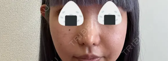 隆鼻術 / 鼻尖形成（切開） / 鼻中隔延長（切開） / 小鼻縮小（切開） / 軟骨移植 R Beauty CLINIC 銀座院 DAY 40 メイン用