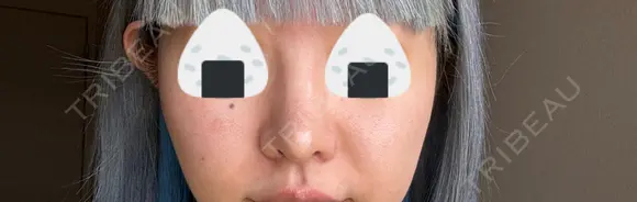 隆鼻術 / 鼻尖形成（切開） / 鼻中隔延長（切開） / 小鼻縮小（切開） / 軟骨移植 R Beauty CLINIC 銀座院 DAY 92 メイン用