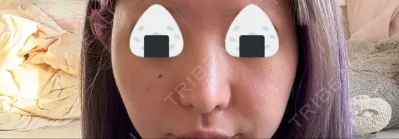 隆鼻術 / 鼻尖形成（切開） / 鼻中隔延長（切開） / 小鼻縮小（切開） / 軟骨移植 R Beauty CLINIC 銀座院 DAY 130 メイン用