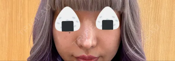 隆鼻術 / 鼻尖形成（切開） / 鼻中隔延長（切開） / 小鼻縮小（切開） / 軟骨移植 R Beauty CLINIC 銀座院 AFTER メイン用