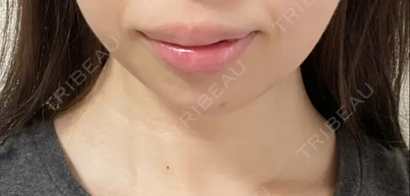 ボトックス（あご） A CLINIC（エークリニック） 新宿院 DAY 4 メイン用