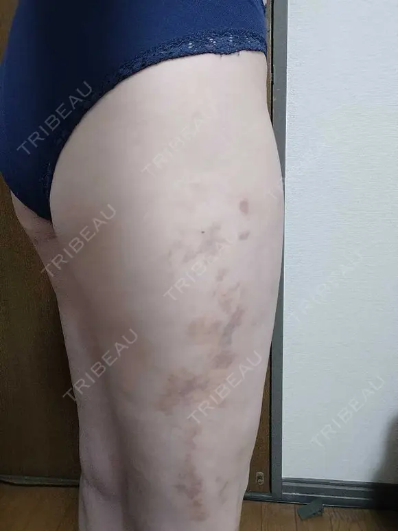 豊胸（脂肪注入） 銀座マイアミ美容外科 DAY 15 メイン用
