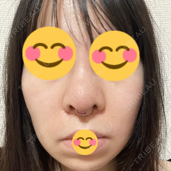 鼻尖形成（切開） / 鼻中隔延長（切開） / 小鼻縮小（切開） / バッカルファット除去 / 脂肪吸引（顔） / 軟骨移植 / 眉間プロテーゼ / 鼻尖縮小 ジョウクリニック 大阪院 DAY 21 メイン用