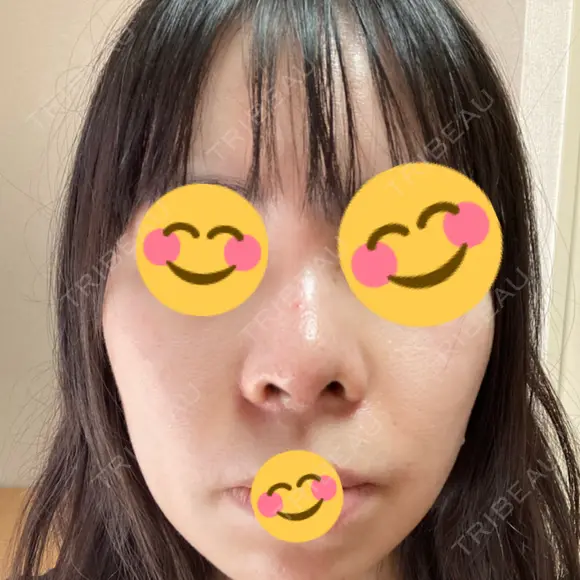 鼻尖形成（切開） / 鼻中隔延長（切開） / 小鼻縮小（切開） / バッカルファット除去 / 脂肪吸引（顔） / 軟骨移植 / 眉間プロテーゼ / 鼻尖縮小 ジョウクリニック 大阪院 AFTER メイン用