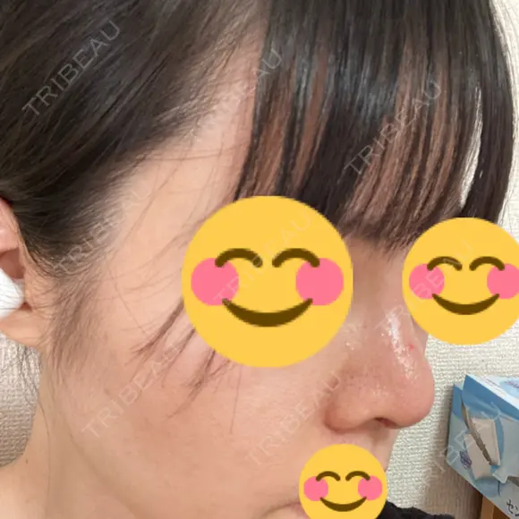 鼻尖形成（切開） / 鼻中隔延長（切開） / 小鼻縮小（切開） / バッカルファット除去 / 脂肪吸引（顔） / 軟骨移植 / 眉間プロテーゼ / 鼻尖縮小 ジョウクリニック 大阪院 DAY 38 メイン用