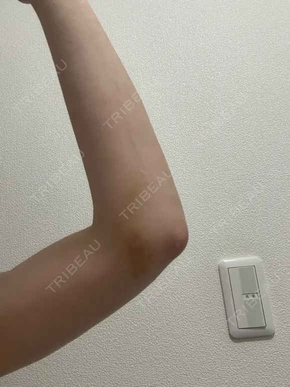 脂肪吸引（二の腕） イテウォンビューティークリニック 名古屋栄院 DAY 20 メイン用