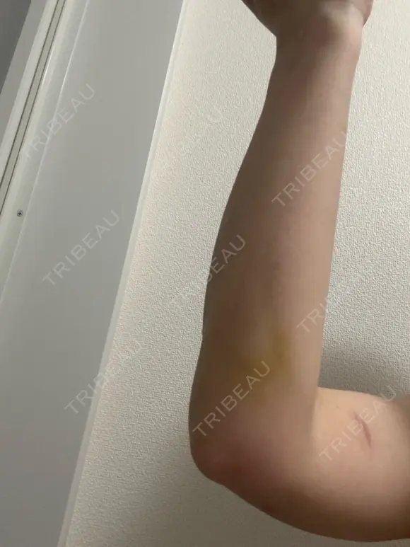 脂肪吸引（二の腕） イテウォンビューティークリニック 名古屋栄院 DAY 20 メイン用