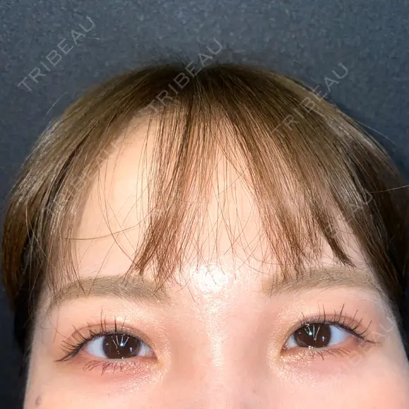 二重埋没 / クマ治療 R Beauty CLINIC 名古屋院 AFTER メイン用