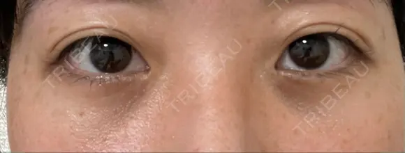 クマ治療 湘南美容クリニック 千葉センシティ院 DAY 45 メイン用