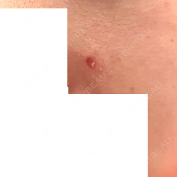 ほくろ・いぼ除去レーザー（肌） フェアクリニック川口 DAY 9 メイン用