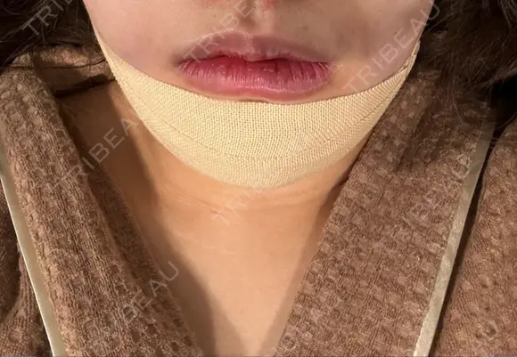 骨切り（あご） / 脂肪吸引（顔） / ジョールファット除去 銀座マイアミ美容外科 DAY 0 メイン用