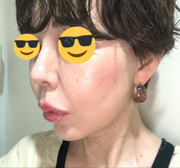 ヒアルロン酸注入（鼻） プリモ麻布十番クリニック DAY 5 メイン用