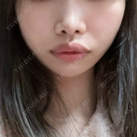 隆鼻術 / 鼻尖形成（切開） / 脂肪吸引（顔） / 軟骨移植 / メーラーファット除去 R Beauty CLINIC 名古屋院 AFTER メイン用