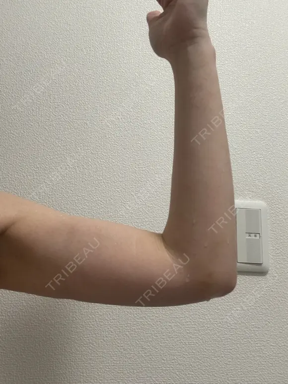 脂肪吸引（二の腕） イテウォンビューティークリニック 名古屋栄院 DAY 21 メイン用