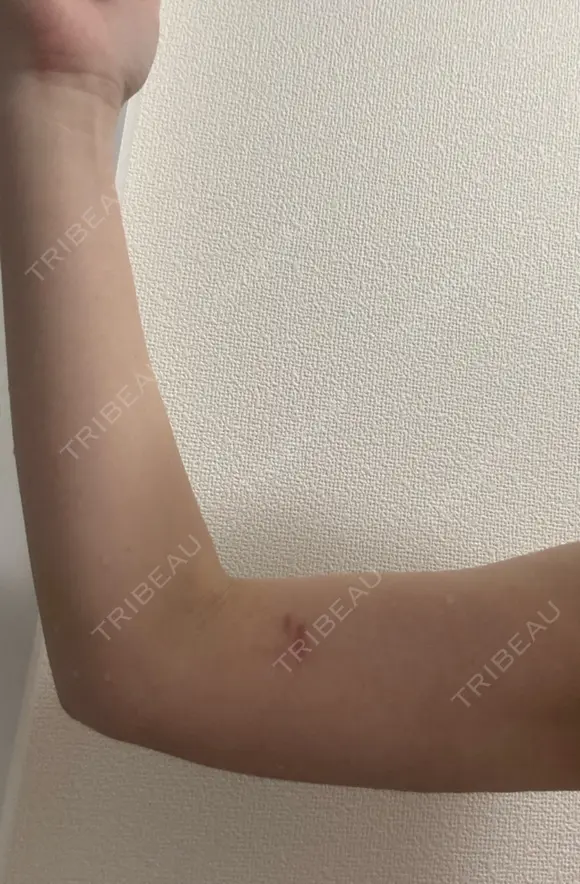 脂肪吸引（二の腕） イテウォンビューティークリニック 名古屋栄院 DAY 21 メイン用