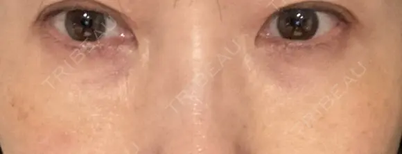 下まぶたの脂肪取り / 脂肪注入（肌） / 脂肪注入（目の下） X CLINIC 大阪院 DAY 14 メイン用